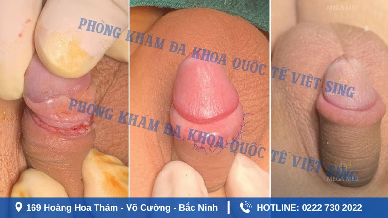 Hình ảnh sau khi cắt bao quy đầu từ 1 - 3 ngày đầu