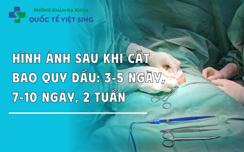 https://dakhoaquoctebacninh.com/wp-content/uploads/2024/05/hinh-anh-sau-khi-cat-bao-quy-dau-qua-tung-giai-doan.jpg