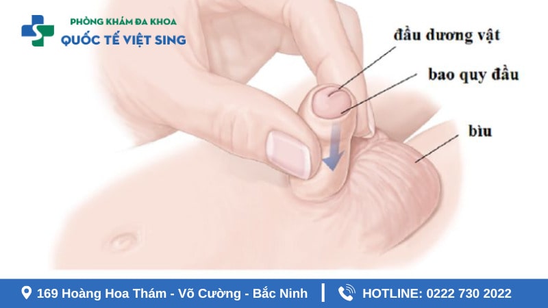 Lợi ích khi thực hiện lột bao quy đầu