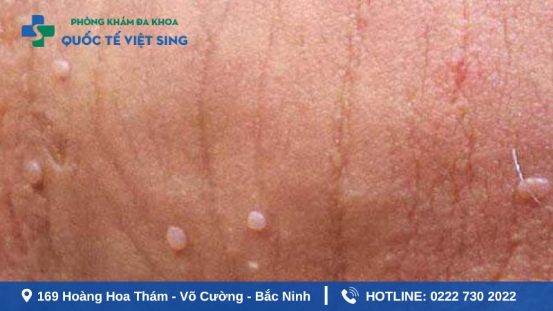 Nốt mụn nhỏ ở rãnh bao quy đầu do sùi mào gà