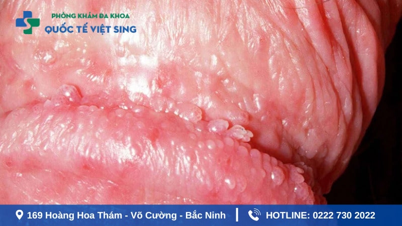 Viêm bao quy đầu nổi mụn bất thường cần chú ý