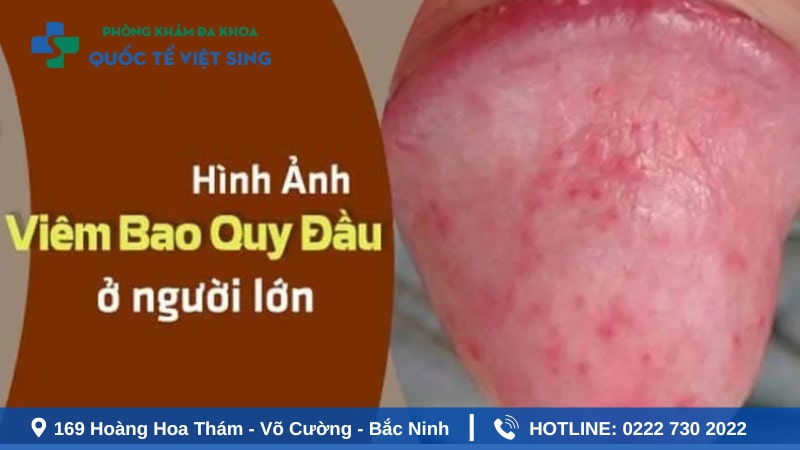 Nguyên nhân viêm bao quy đầu ở nam giới