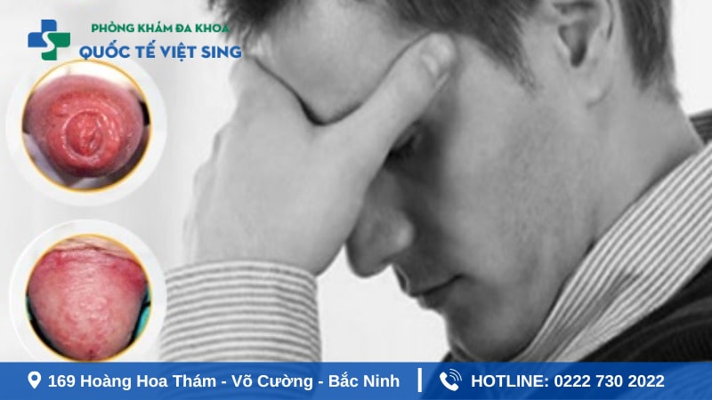 Nổi mụn nhỏ trắng ở rãnh bao quy đầu có nguy hiểm không