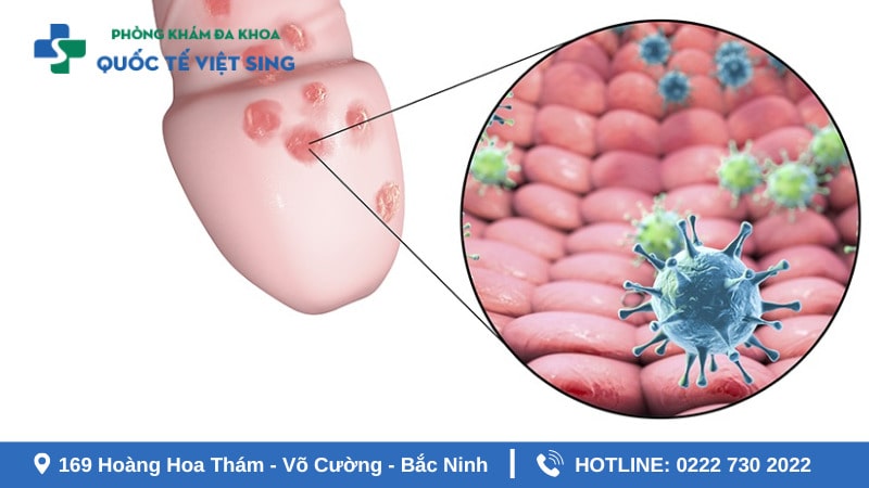 Mụn nhỏ đầu trắng ở bao quy đầu: Hiện tượng gì?