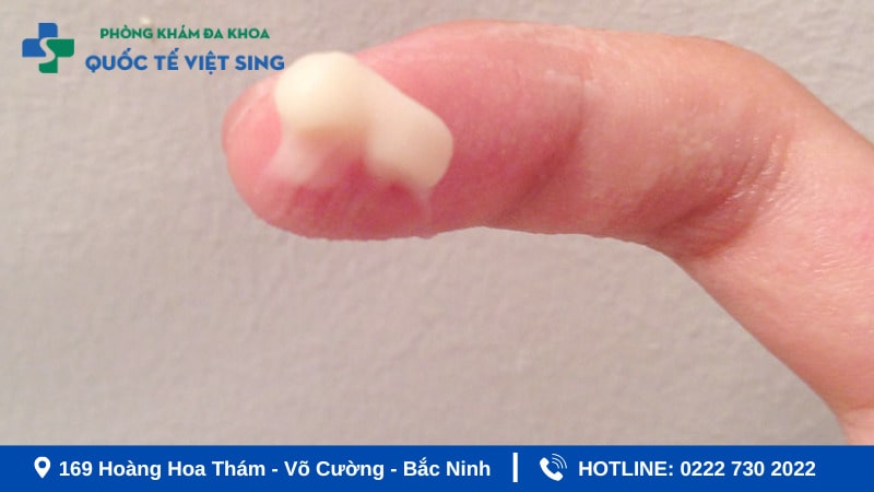 Các loại khí hư bất thường theo kết cấu