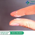 [Góc giải đáp] Khí hư bã đậu là bệnh gì? 