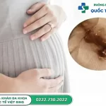 Khí hư bất thường khi mang bầu: Biểu hiện, nguyên nhân và cách xử lý