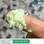 Khí hư màu xanh vón cục như bã đậu bệnh gì? Cách chữa tại nhà