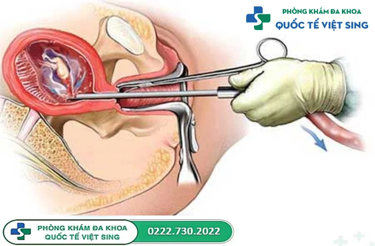 Đâu là phương pháp phá thai an toàn dành cho thai phụ đang cho con bú?