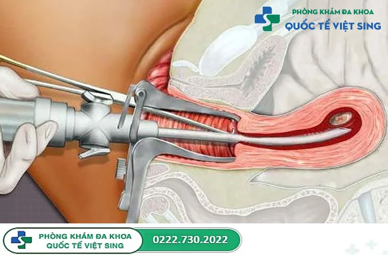 Cách phá thai an toàn, hiệu quả cao mà ít biến chứng là gì?