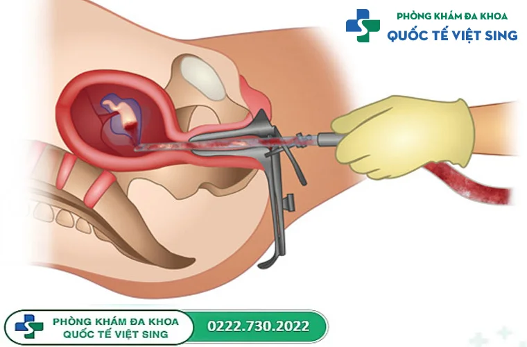 Tiết lộ cách phá thai an toàn và tốt nhất: Hút thai chân không