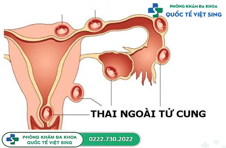 Mang thai ngoài tử cung là gì?