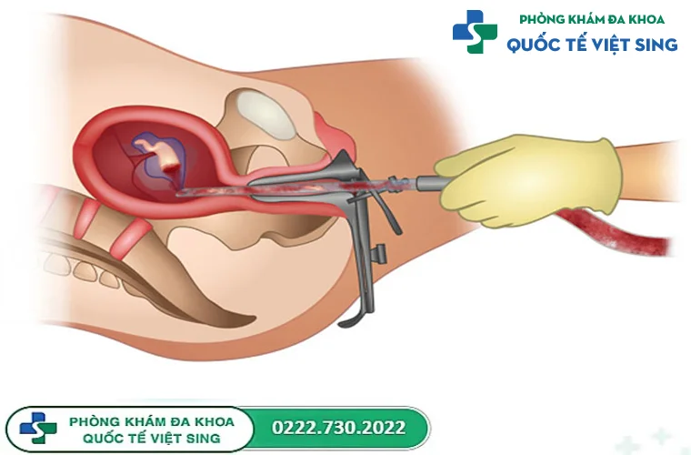 Phương pháp phá thai 5 tuần tuổi an toàn