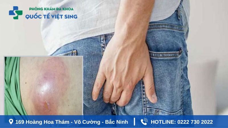5 biến chứng nguy hiểm khi áp xe hậu môn tự vỡ 