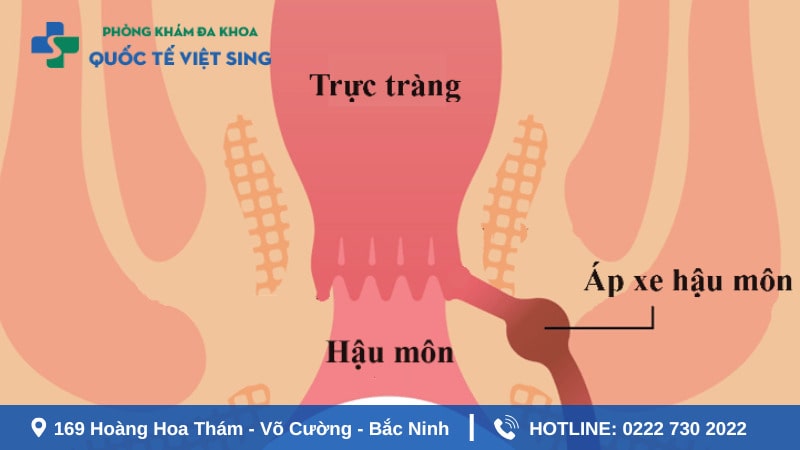 Áp xe hậu môn là gì?