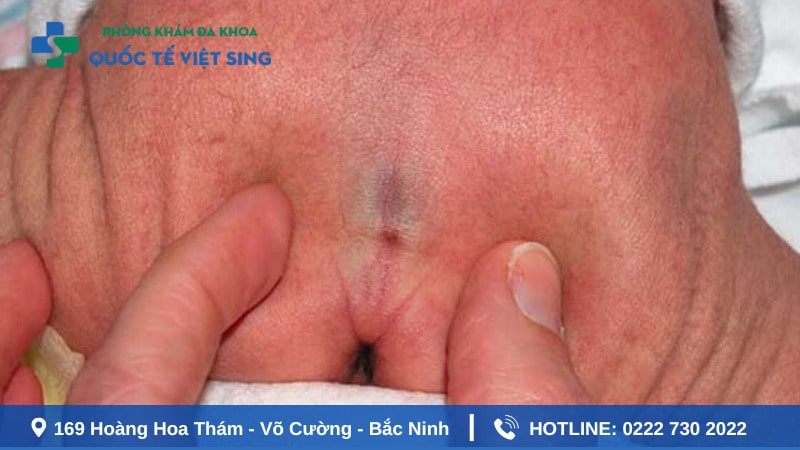 Áp xe hậu môn ở trẻ nhỏ khiến da bị đỏ và sưng
