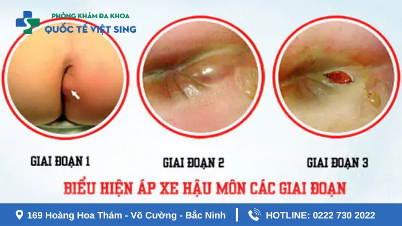 Áp xe hậu môn có tự khỏi không?