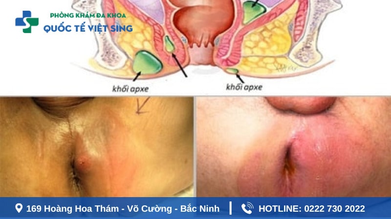 Áp xe hậu môn tự vỡ do nguyên nhân nào?