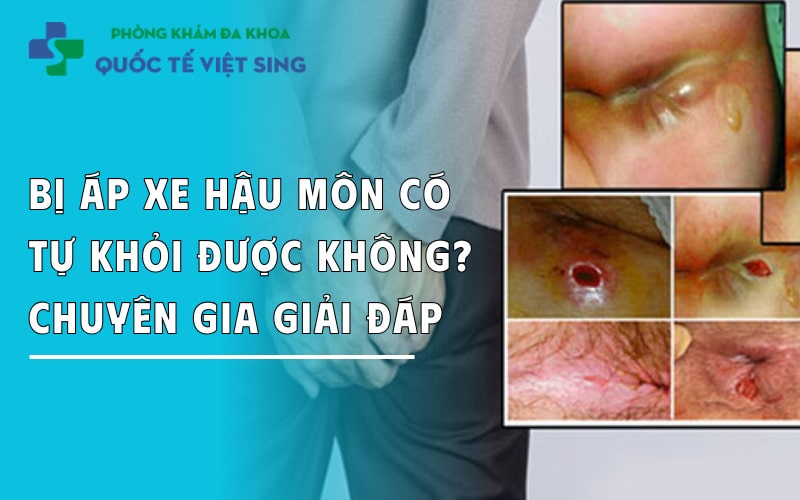 https://dakhoaquoctebacninh.com/wp-content/uploads/2025/05/bi-ap-xe-hau-mon-co-tu-khoi-duoc-khong.jpg