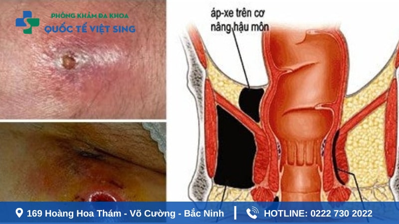 Áp xe hậu môn là gì?