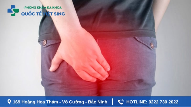Nếu bị trĩ gây ngứa hậu môn phải làm sao?