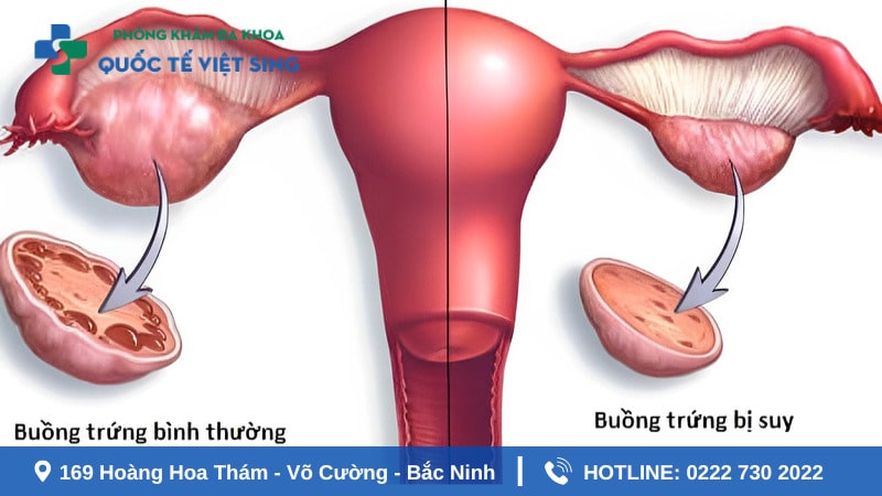 Chậm kinh nguyệt do hội chứng buồng trứng đa năng