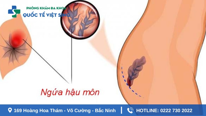 Chi tiết chi phí khám ngứa hậu môn hiện nay