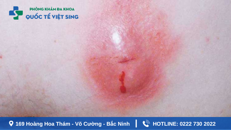 Áp xe hậu môn gây sưng, đau cho trẻ
