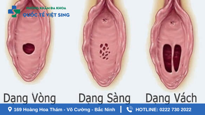 Các dạng màng trinh khi chưa bị rách