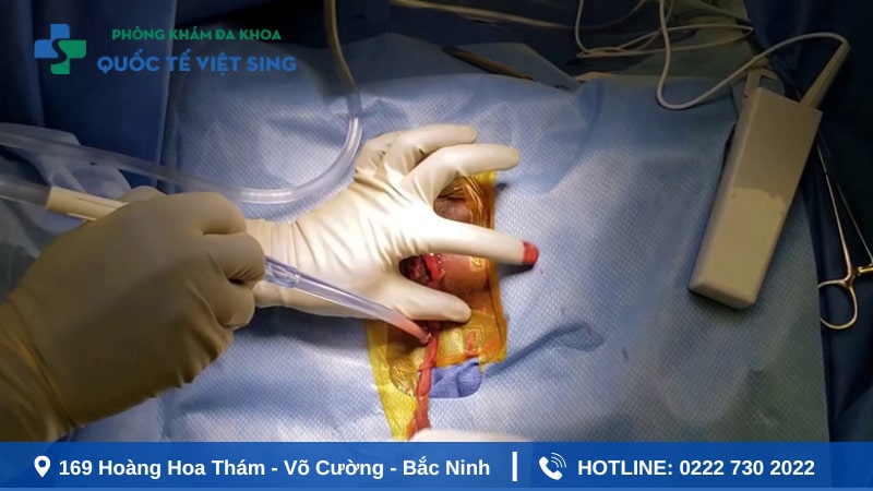 Địa chỉ mổ áp xe hậu môn phục hồi nhanh chóng 