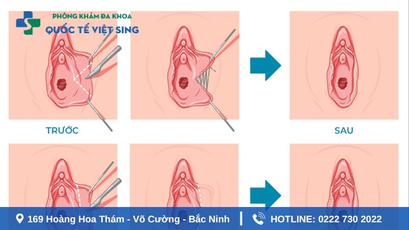 Dịch vụ thu hẹp âm đạo phổ biến hiện nay