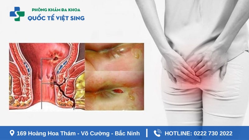 Điều trị áp xe hậu môn thế nào để hạn chế biến chứng?