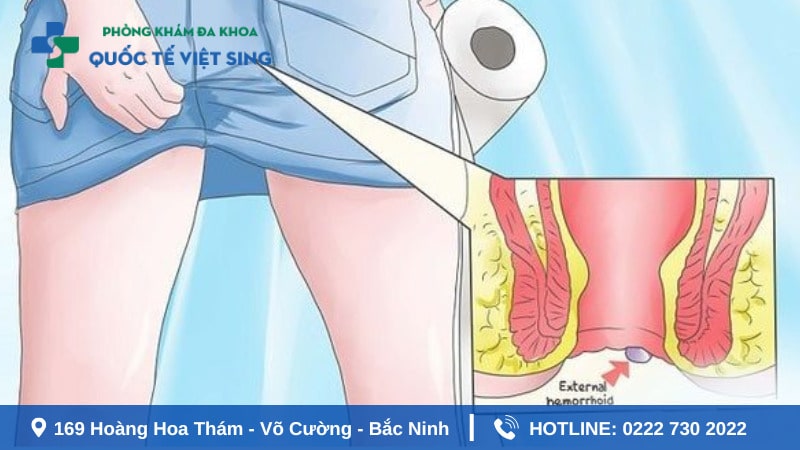 Điều trị ngứa hậu bằng cách nào ?