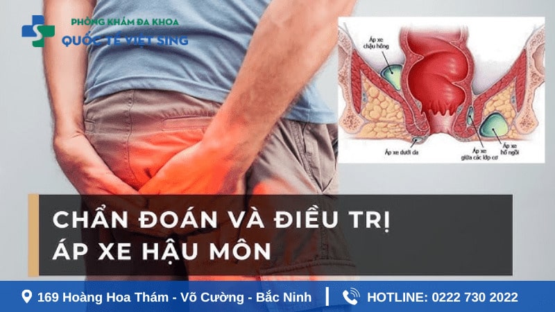 Khám áp xe hậu môn như thế nào?