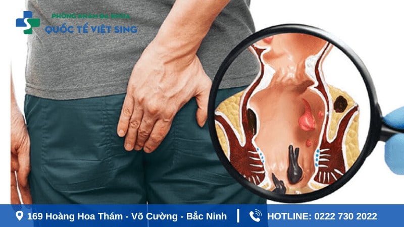 Khám áp xe hậu môn ở đâu uy tín tại Bắc Ninh