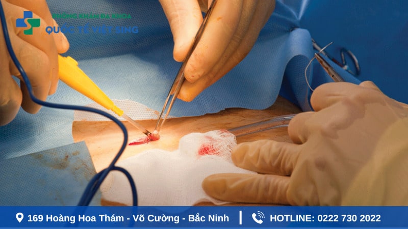Làm sao để hạn chế áp xe hậu môn tái phát?