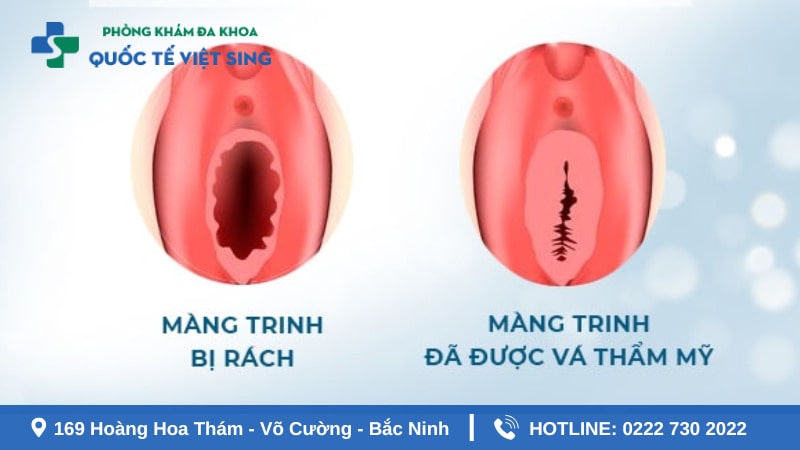Lợi ích của các phương pháp vá màng trinh