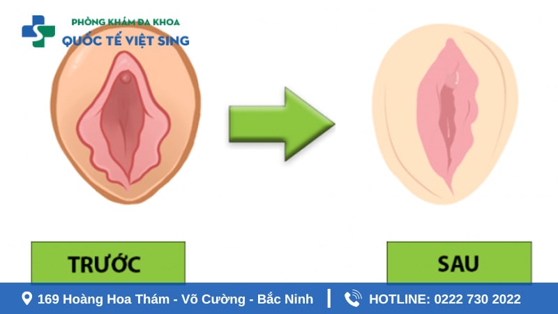 Lợi ích của các bài tập thu hẹp vùng kín