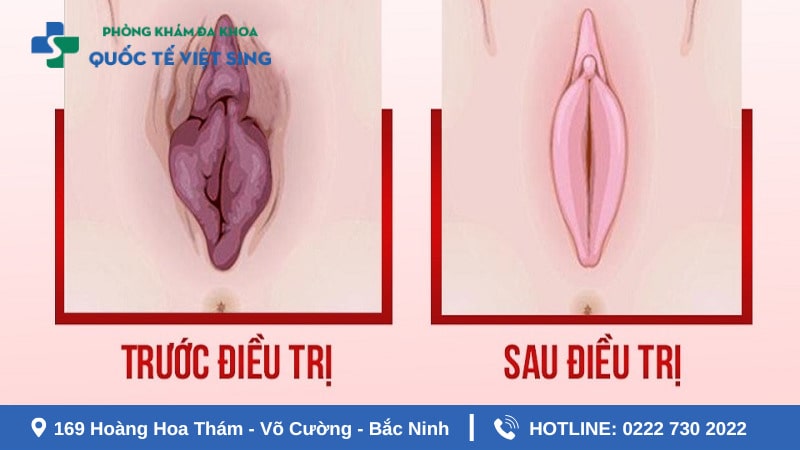 Lợi ích tuyệt vời khi thu hẹp tầng sinh môn