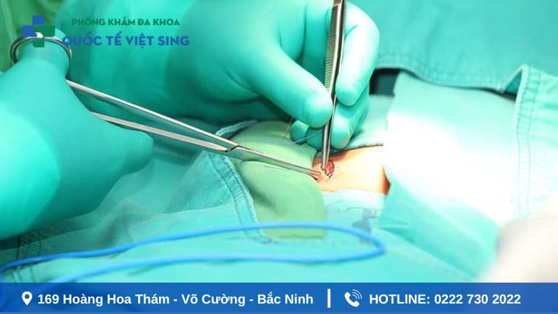 Lưu ý quan trọng sau phẫu thuật áp xe hậu môn