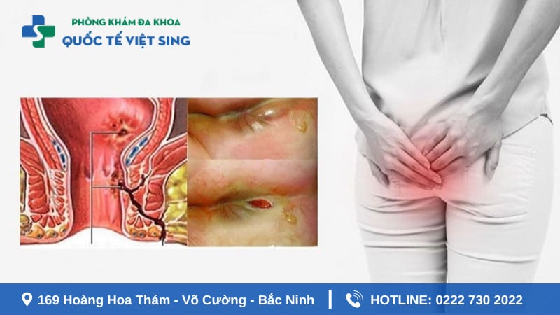 Cần lưu ý gì trước và sau khi điều trị áp xe hậu môn