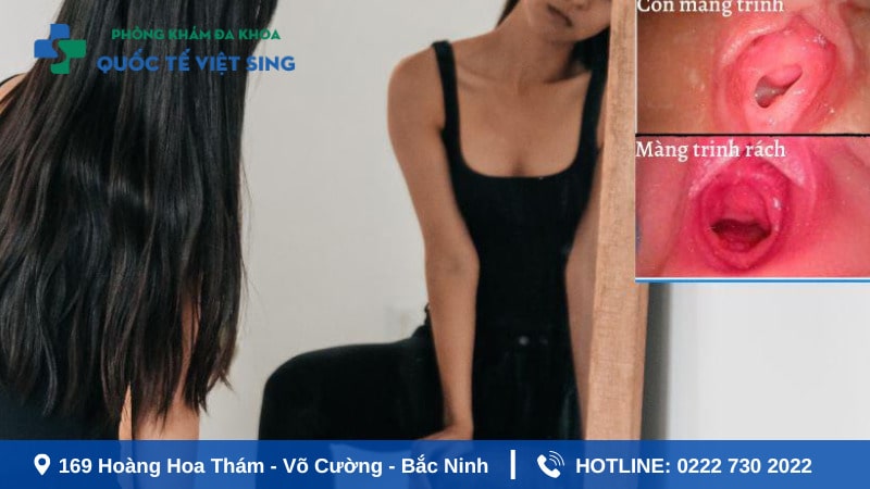 Màng trinh dạng vách ngăn là gì?
