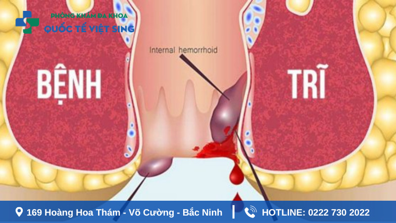 Ngứa hậu môn sau khi đi vệ sinh có thể do trĩ