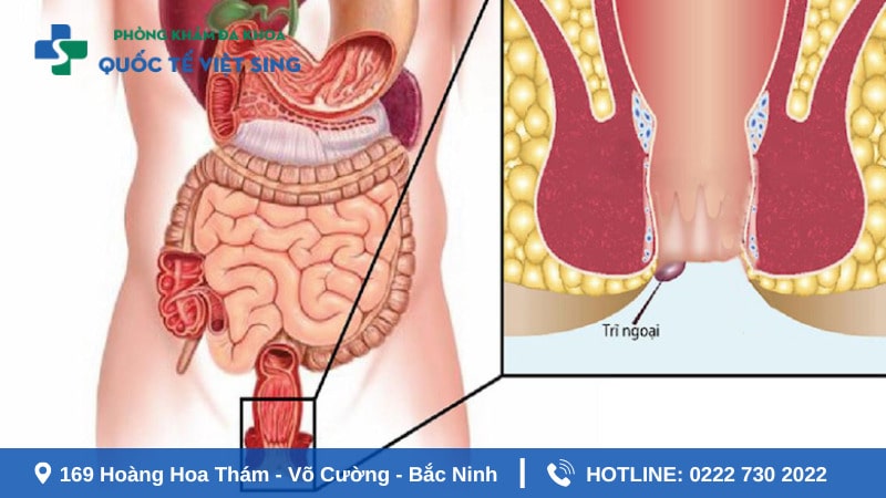 Viêm đại trực tràng cũng là nguyên nhân gây ngứa hậu môn