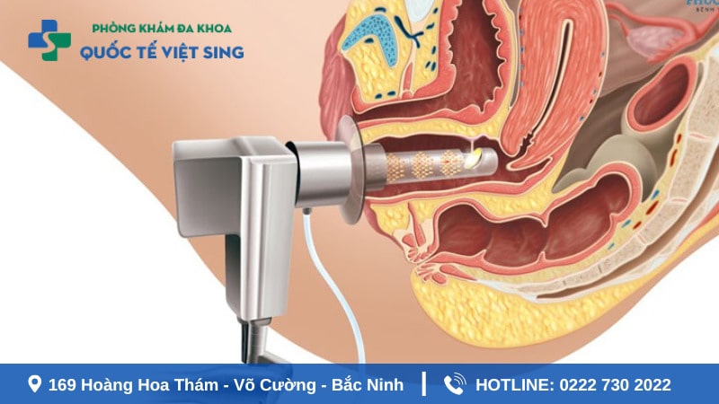 Những ai nên thực hiện thu hẹp vùng kín bằng laser?