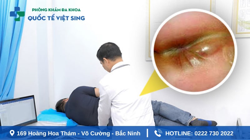 Phẫu thuật áp xe hậu môn là gì? Có cần thiết không?