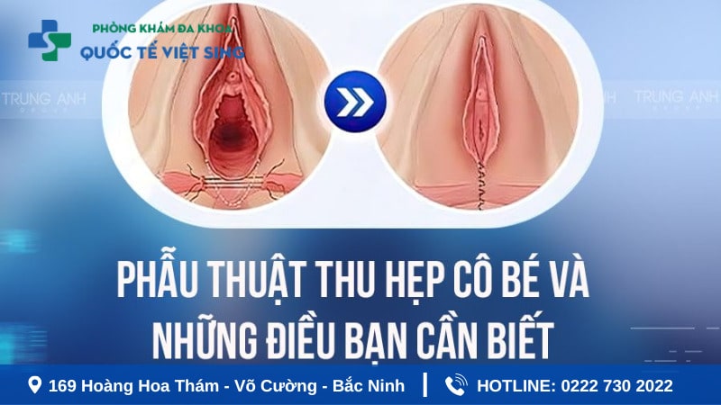 Phẫu thuật thu hẹp vùng kín là gì ?
