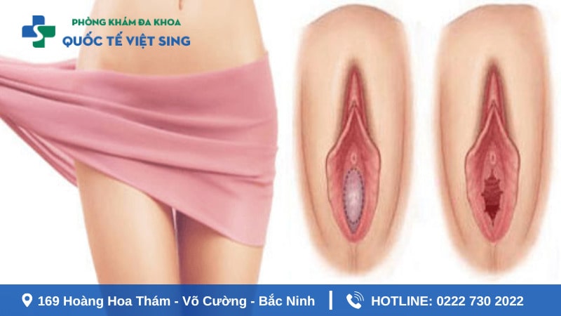 Thời gian lành phụ thuộc vào phương pháp thực hiện