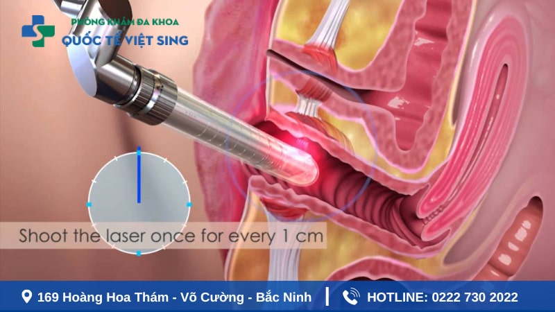 Review quy trình thu hẹp vùng kín bằng
