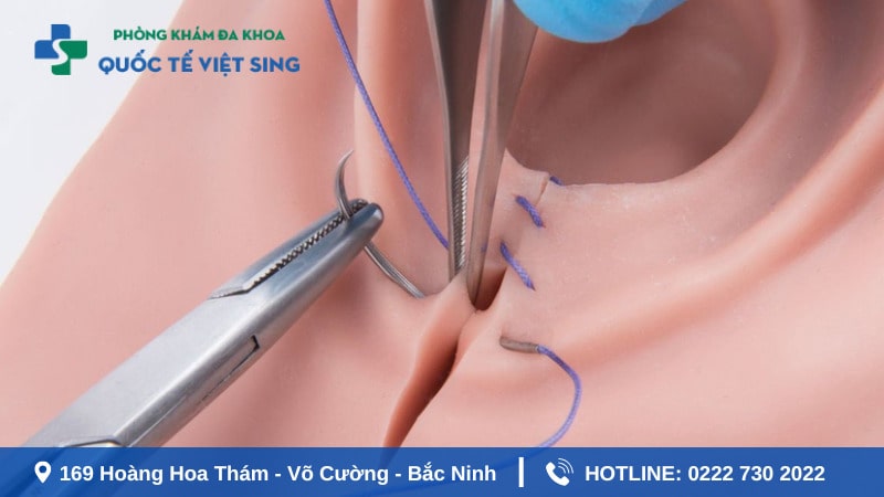 Tại sao phải vá màng trinh?